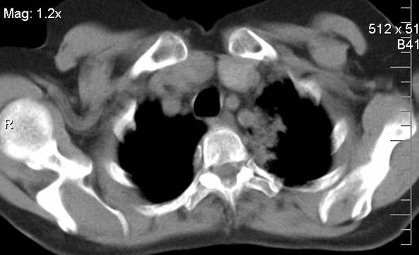 ct1