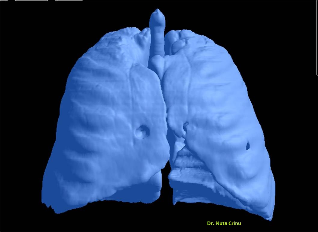 meta_pulmonar01