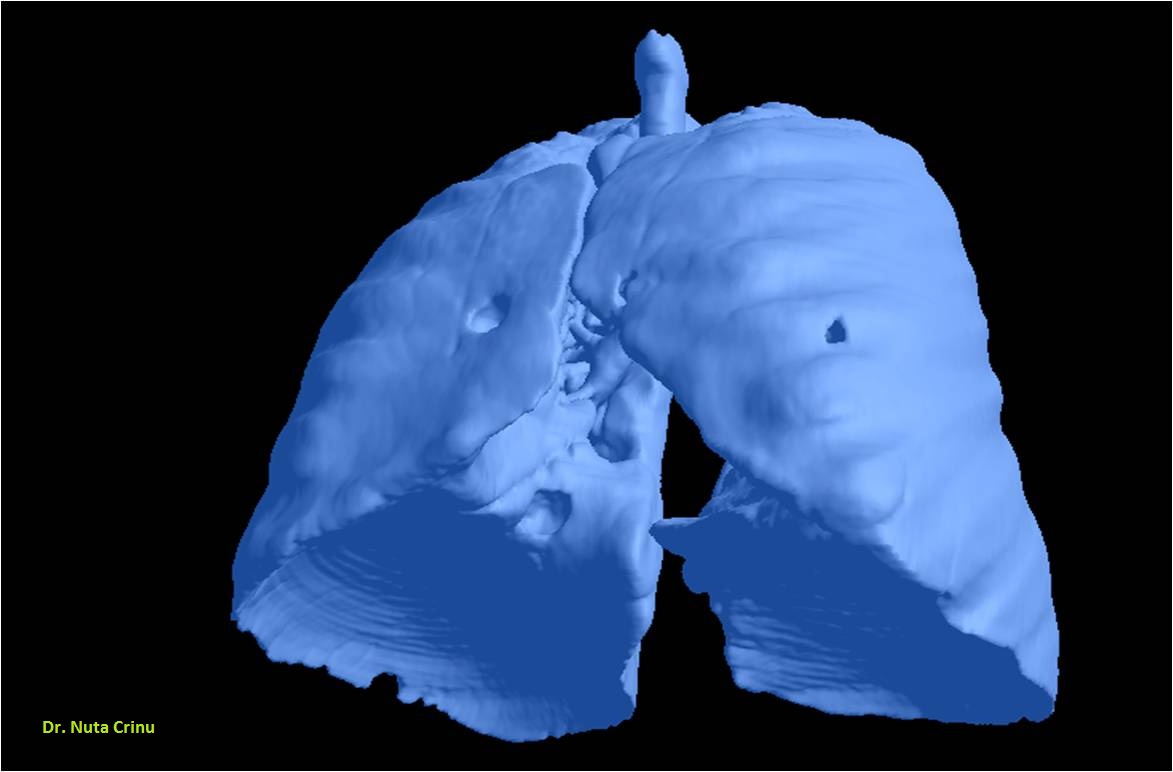 meta_pulmonar02