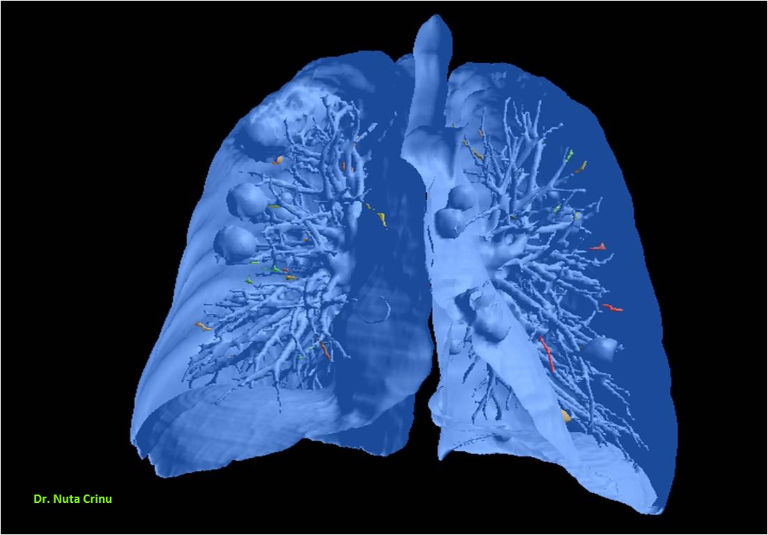 Meta_pulmonar04