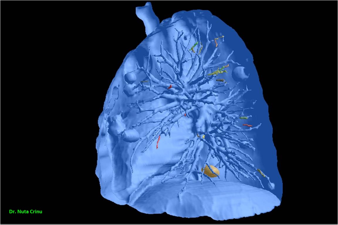 Meta_pulmonar06