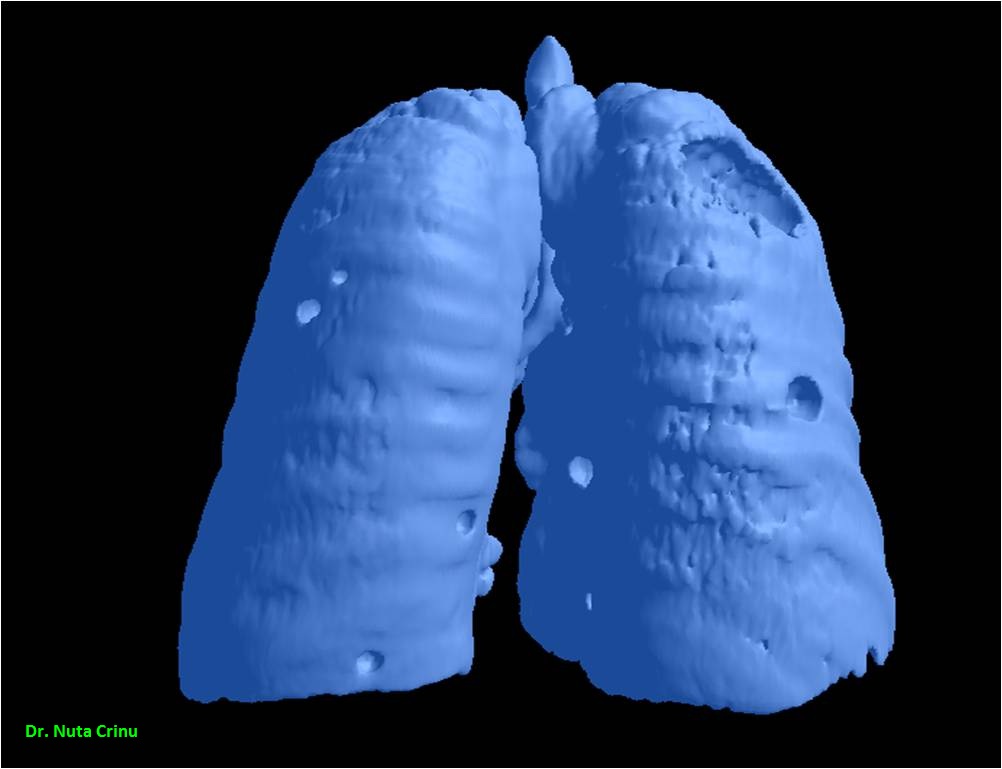 Meta_pulmonar_03
